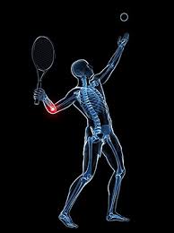 tennis elbow, آرنج تنیس بازان